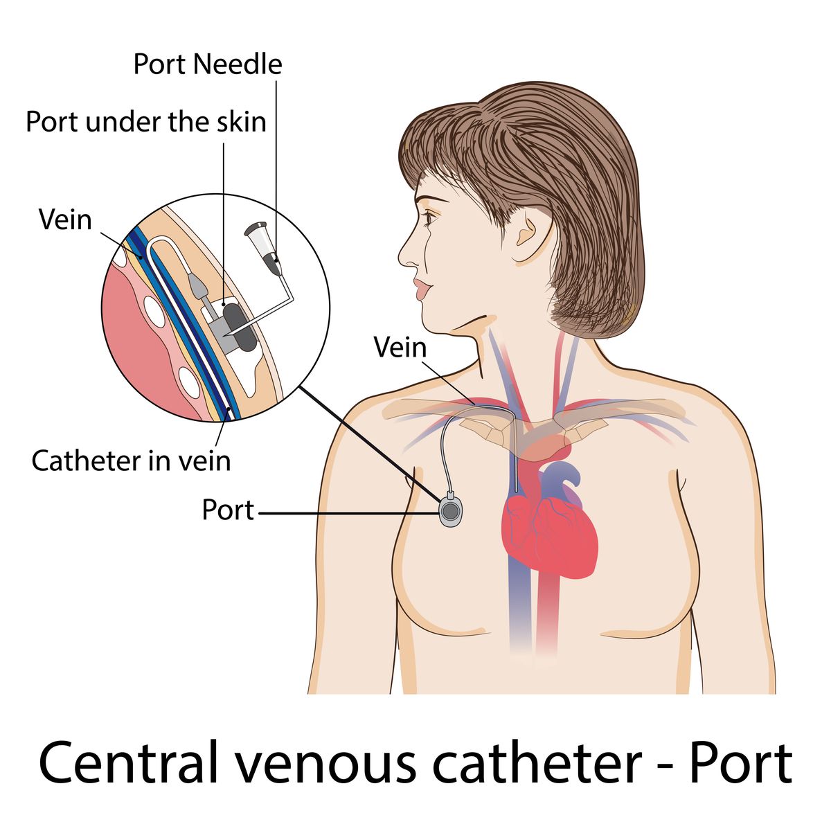 Portacath device